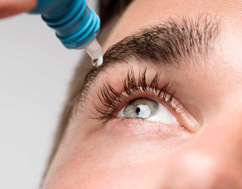 Ilustración del ojo afectado por glaucoma